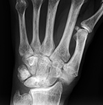 Trapezium prosthesis